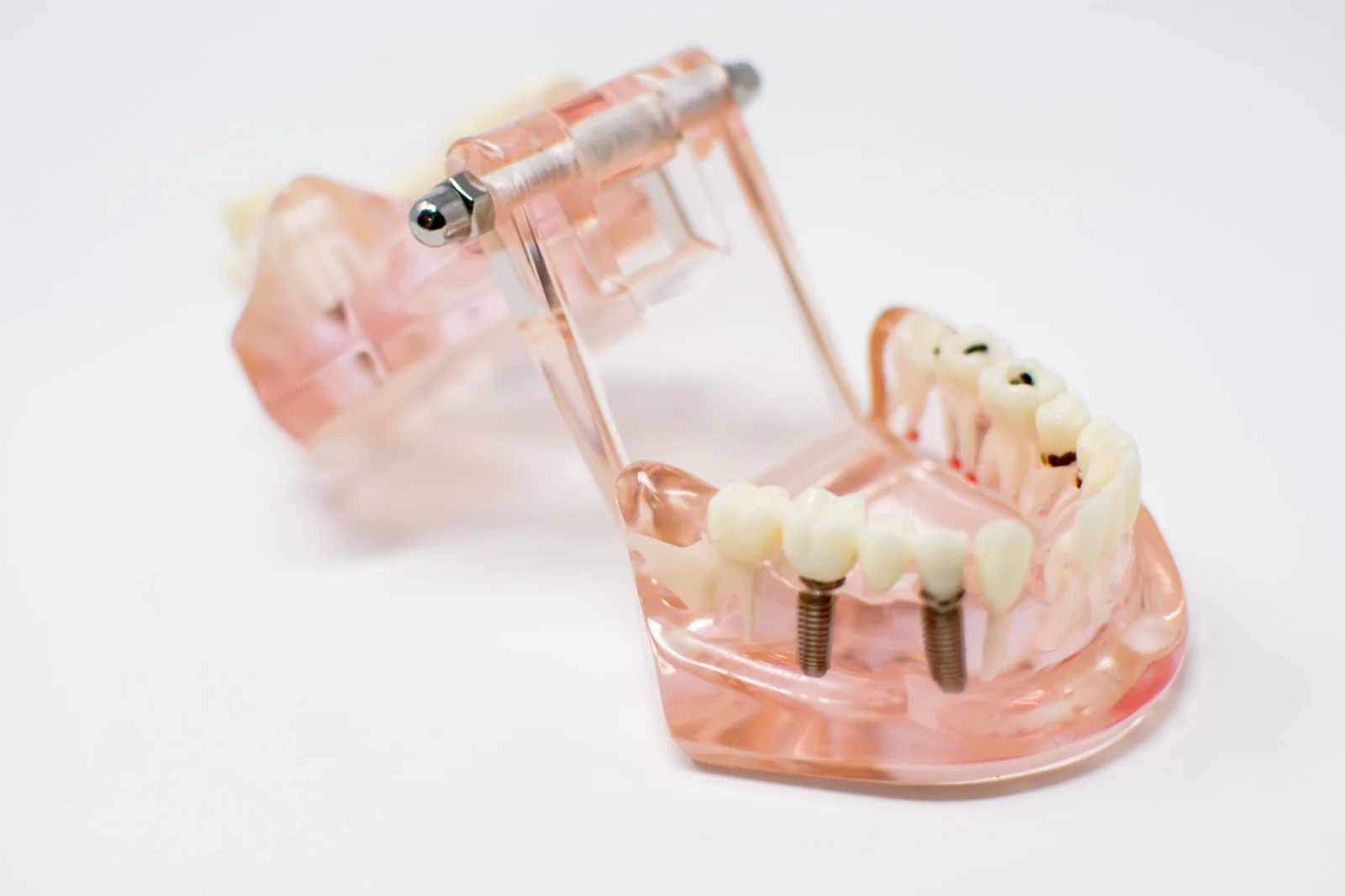 Why Dental Implants?