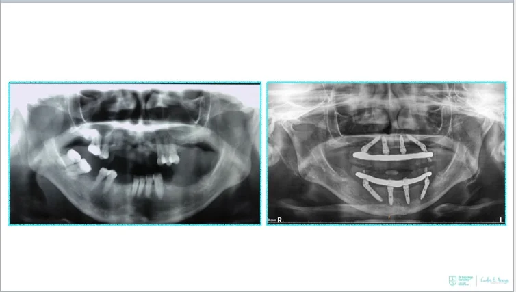 Patients With Bone Loss