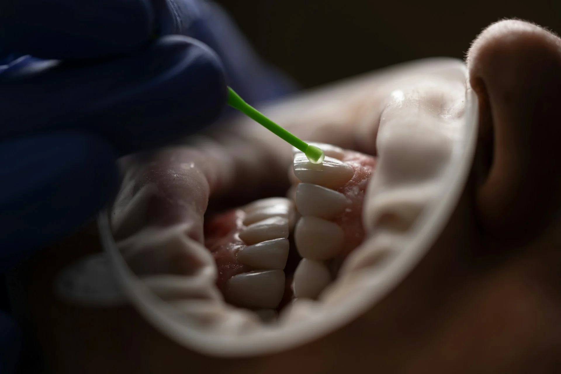How Dental Sealants Protect Against Cavities